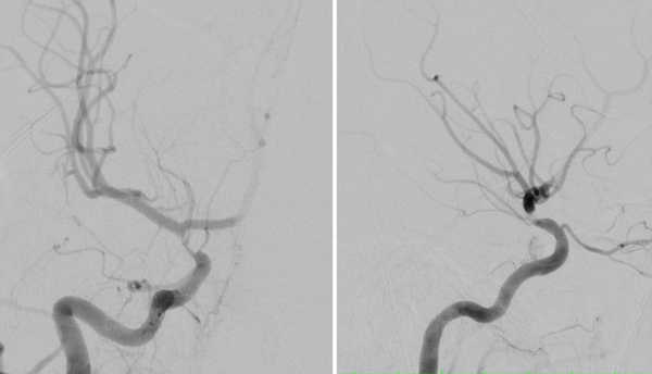 The-Youngest-Challenge-Emergency-Stenting-for-Pediatric-Ischemic-Stroke-figure9