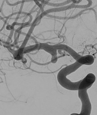 The aneurysm had a wide neck 