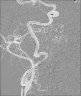 the ipsilateral carotid artery was extremely tortuous