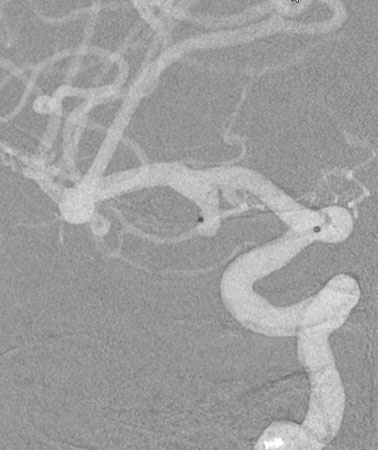 the microcatheter tip is positioned well deep inside the aneurysm