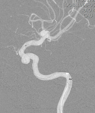 the aneurysm is directed posteriorly and is not aligned with the axis of the proximal middle cerebral artery