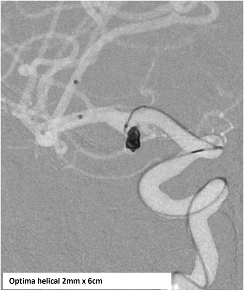 Wide-neck-MCA-aneurysm-figure3B