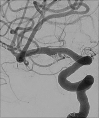 complete aneurysm occlusion without any hemorrhagic or ischemic complication