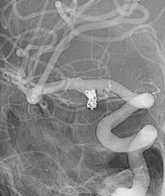 complete aneurysm occlusion without any hemorrhagic or ischemic complication figure 4D