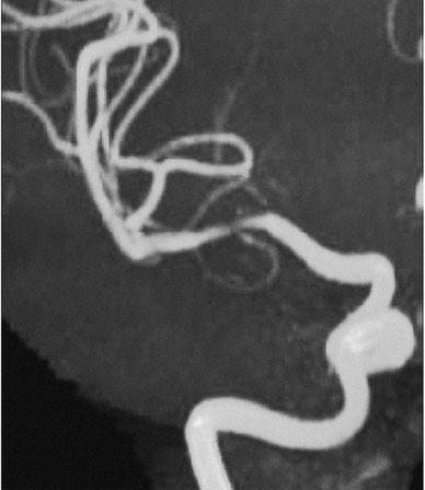 Control MR angiography at 18 months 