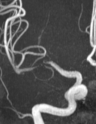 the treated aneurysm despite artefactual parent arterial stenosis at the stented MCA segment 