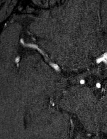 Control MR angiography at 42 months the patency of the stented segment 