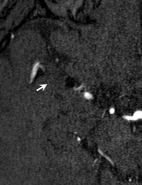 Control MR angiography at 42 months : complete occlusion of the aneurysm 