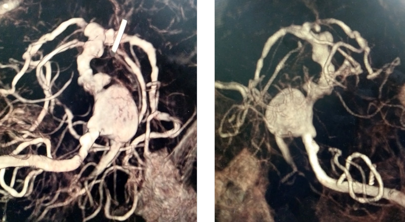 3D CT angiography