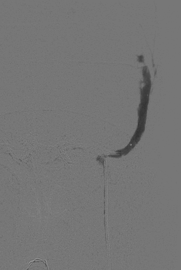50% glue injection in left sigmoid sinus fistula