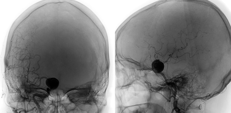 A 18-mm ICA aneurysm