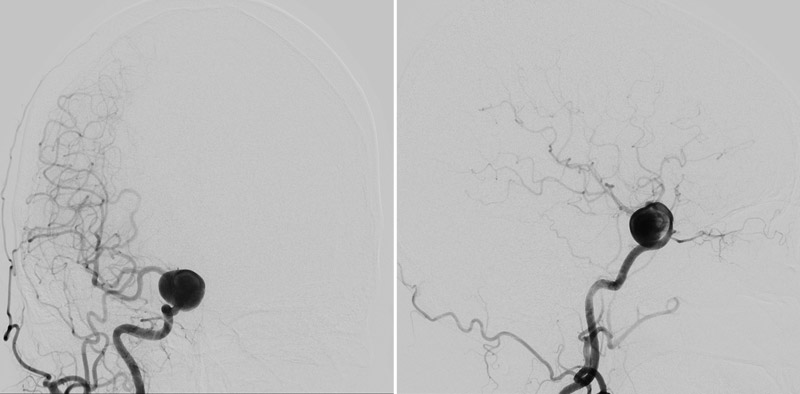 A 18-mm ICA aneurysm