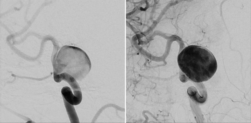 A 18-mm ICA aneurysm