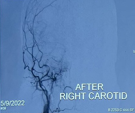 After Balloon Occlusion