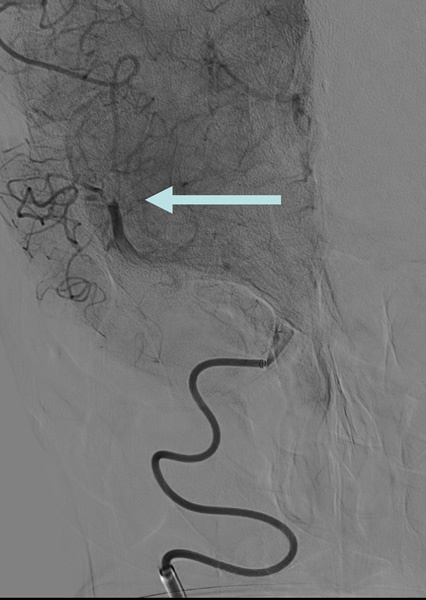M2 occlusion of the inferior division of the MCA
