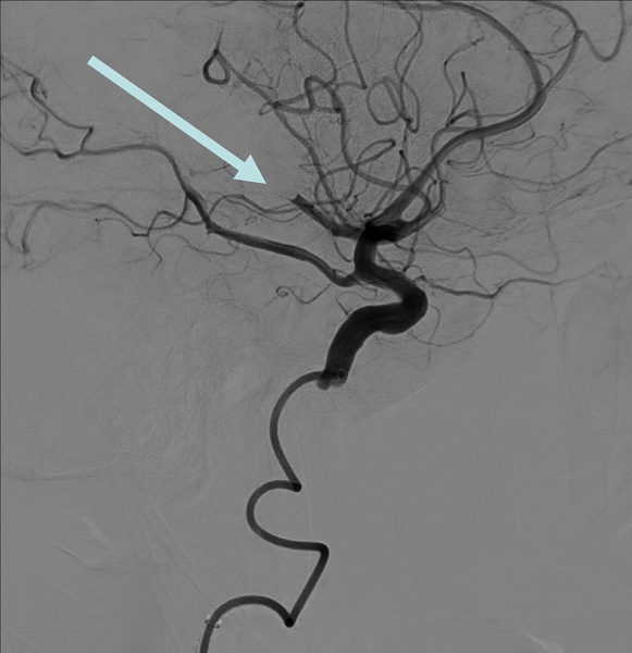 M2 occlusion of the inferior division of the MCA