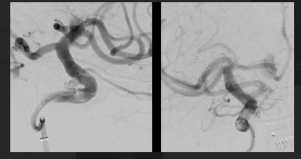 Complex anterior communicating artery (ACoA) aneurysm treatment