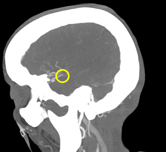 AngioCT: M2 left occlusion