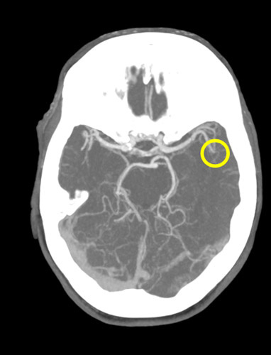 AngioCT: M2 left occlusion
