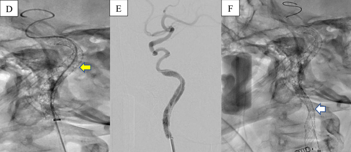 Angiography after the first stent