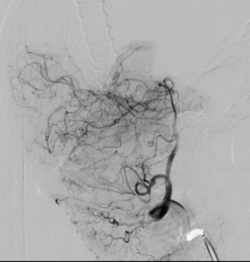 Angiography of right vertebral after fistula embolization