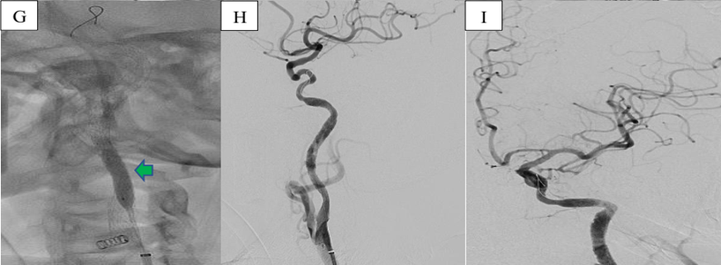 Angioplasty after in-stent restenosis