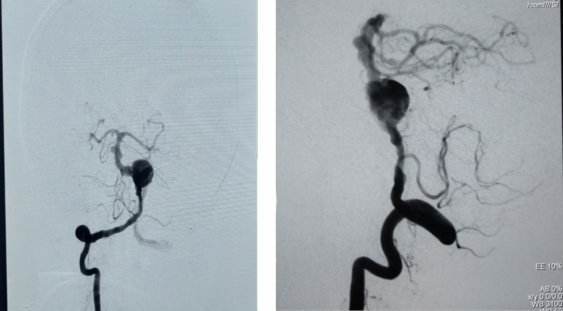 Anteroposterior and Lateral DSA