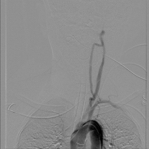 Innominate Rupture Management Ipsilateral Transradial Approach For Management Of Ruptured Vertebro ...
