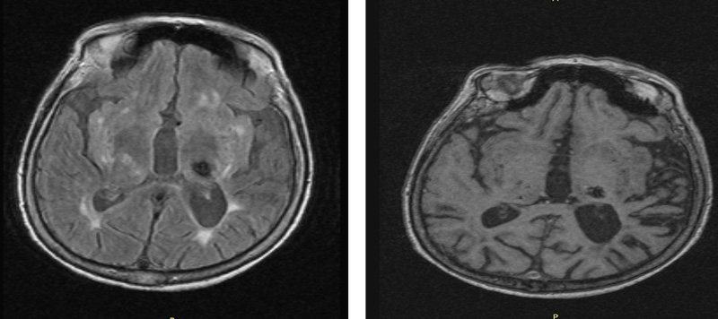 Axial Т2 MR images
