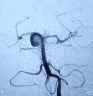 Basilar artery (BA)-SCA junction