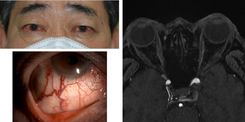 Bilateral conjunctival injections with discomfort for 2 years