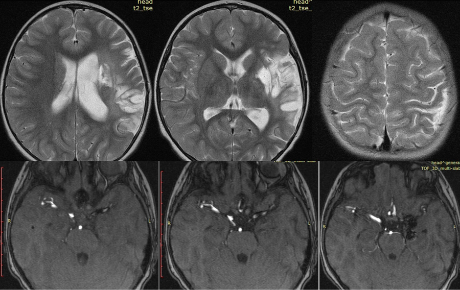 Case of Trombectomy of Accute occluded Flow diverter