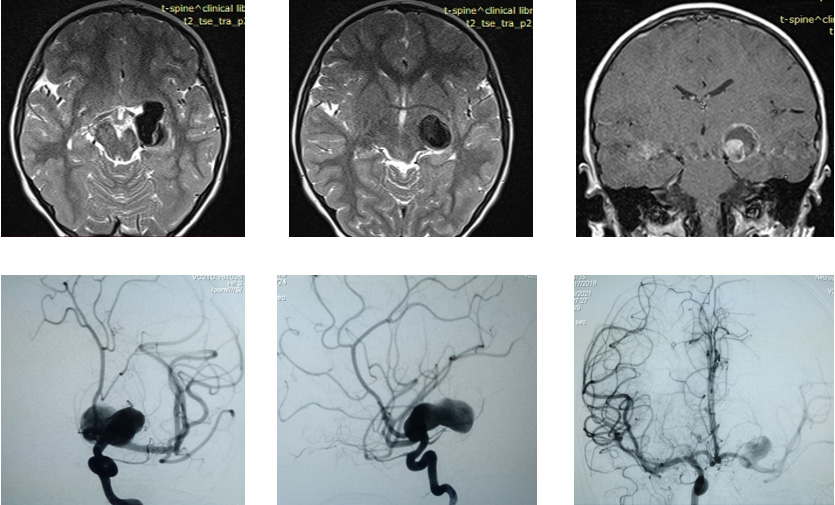 Case of Trombectomy of Accute occluded Flow diverter