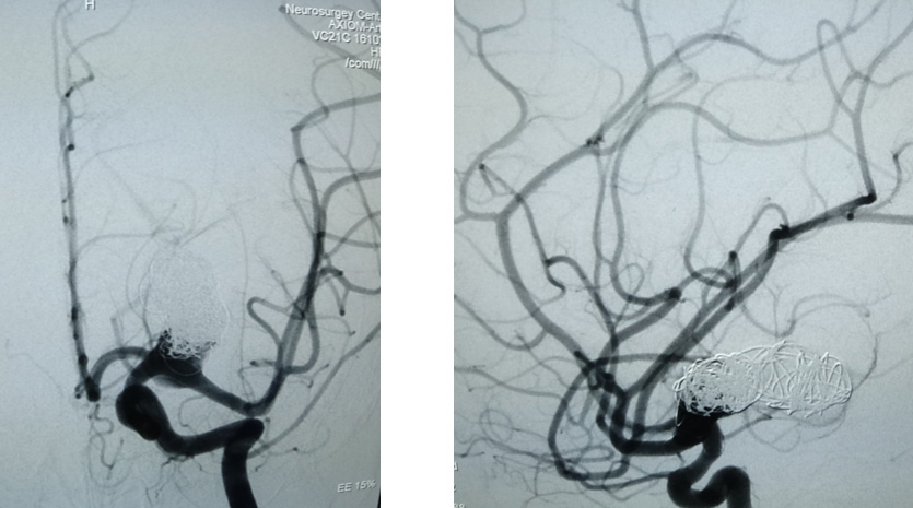 Case of Trombectomy of Accute occluded Flow diverter