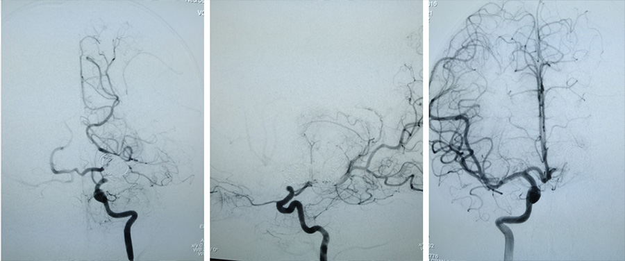 Case of Trombectomy of Accute occluded Flow diverter