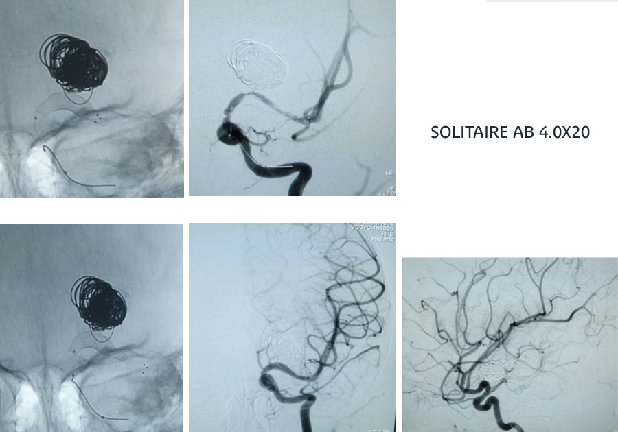 Case of Trombectomy of Accute occluded Flow diverter