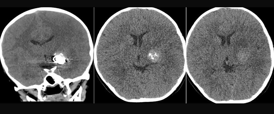 Case of Trombectomy of Accute occluded Flow diverter