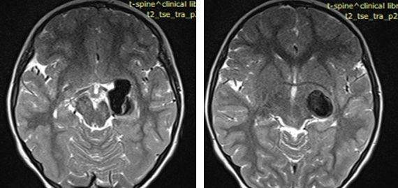 Case of Trombectomy of Accute occluded Flow diverter