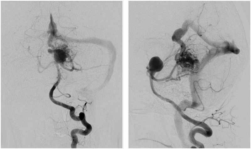 Cerebellar vermis AVM