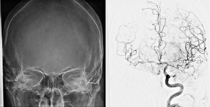Chemical angioplasty for vasospasm