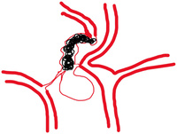 coiling from the Distal end of aneurysm backwards