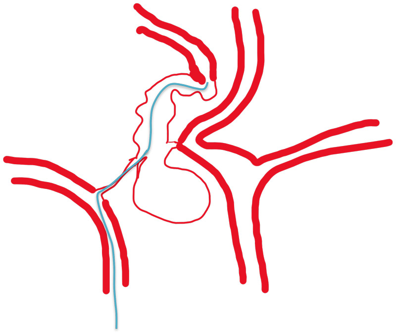 come from right hypoplastic A1 ACA