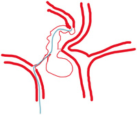 come from right hypoplastic A1 ACA