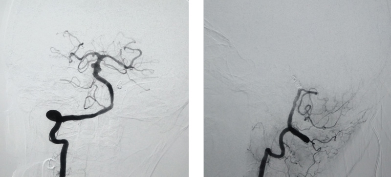 complete occlusion of the VFA