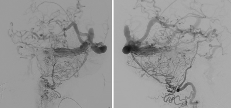 Complex Dural Arterio-Venous fistula- An Unusual Cause of Ischemic Stroke