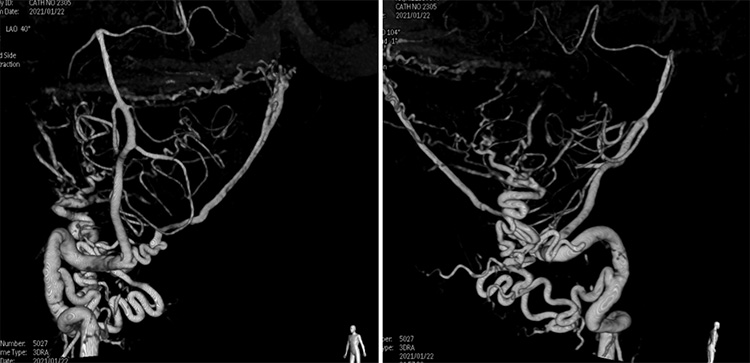 Complex Dural Arterio-Venous fistula- An Unusual Cause of Ischemic Stroke