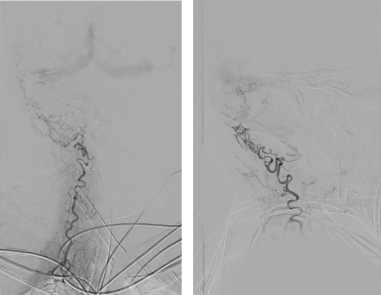 Complex Dural Arterio-Venous fistula- An Unusual Cause of Ischemic Stroke