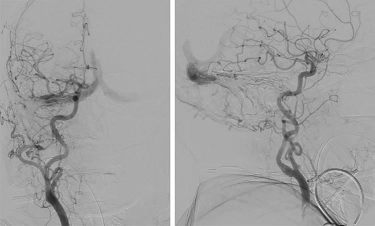 Complex Dural Arterio-Venous fistula- An Unusual Cause of Ischemic Stroke