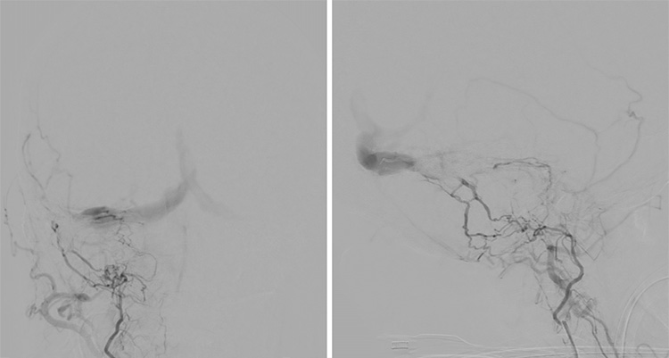 Complex Dural Arterio-Venous fistula- An Unusual Cause of Ischemic Stroke