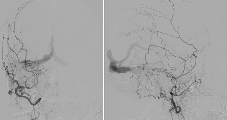 Complex Dural Arterio-Venous fistula- An Unusual Cause of Ischemic Stroke